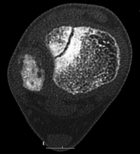 Figure 6 B_CT_Tillaux_Axial